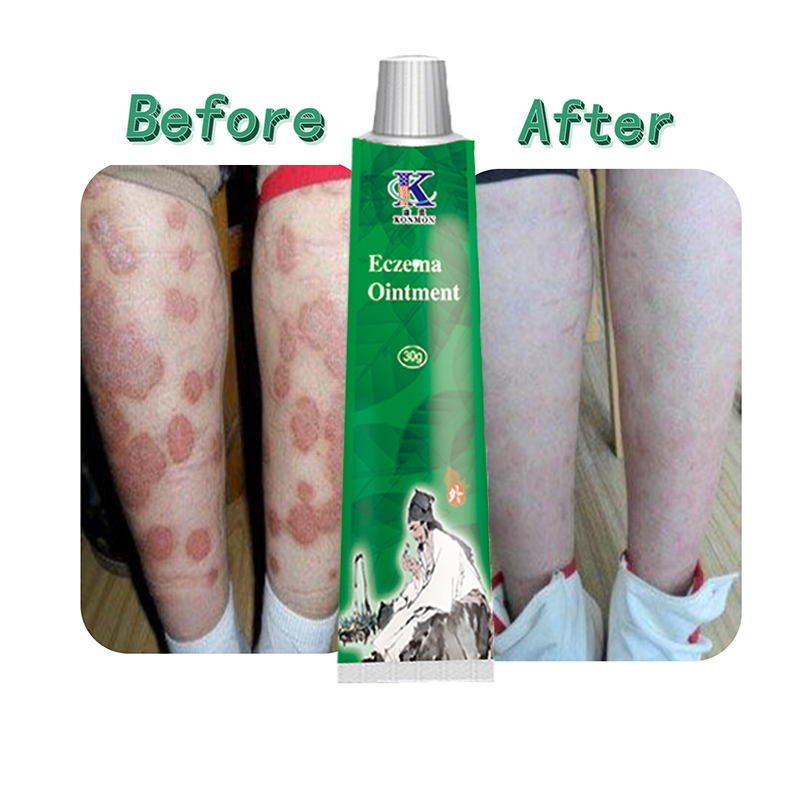 KONMON Skin Problem Treatment Eczema Psoriasis Dermatitis Ointment Herbal Cream Anti Itch Plaster