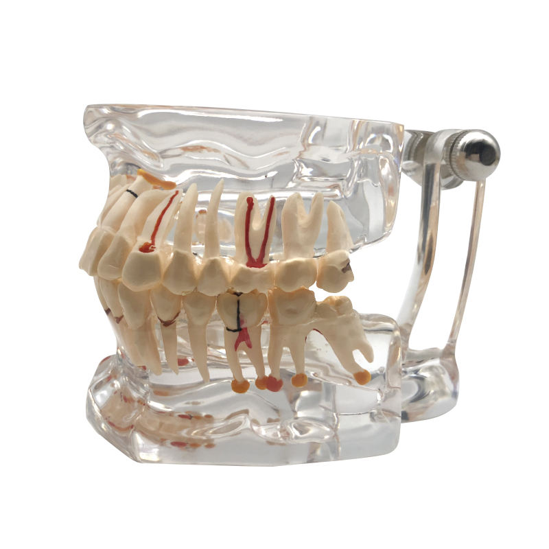 Dental Model Teeth Implant Restoration Bridge Teaching Study Tooth Medical Science Disease Dentist Dentistry Products